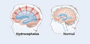 هیدروسفالی در کودکان